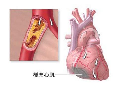 心肌钙蛋白i对于急性心肌梗死的检测指标