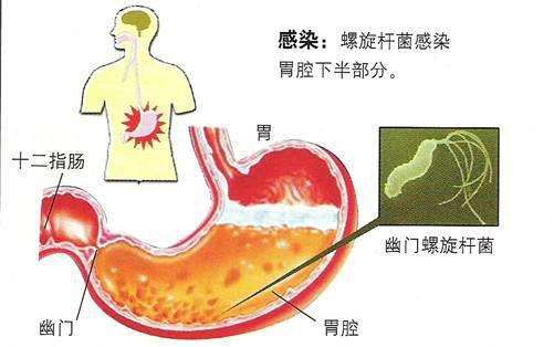 幽门螺旋杆菌如何治疗 幽门螺杆菌治疗药物有哪些 传染病知识 上海凯创生物技术有限公司